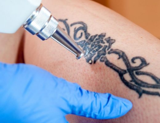 Comment faire disparaître un tatouage