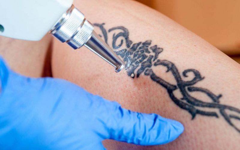 Comment faire disparaître un tatouage